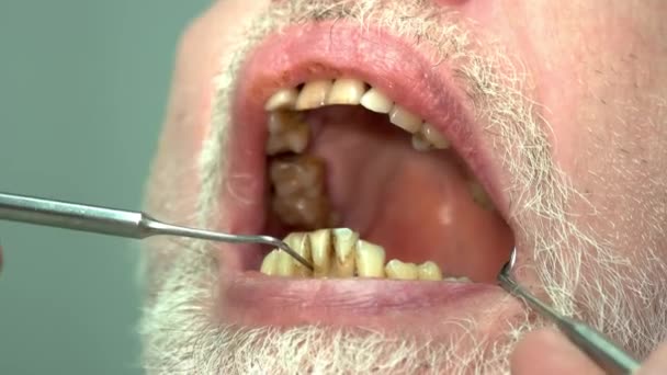 歯医者、悪い歯の患者. - 映像、動画