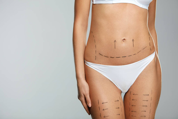 Surgical Lines. Woman Body In White Underwear With Marks On Skin - Valokuva, kuva