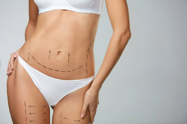 Surgical Lines. Woman Body In White Underwear With Marks On Skin - Photo, image