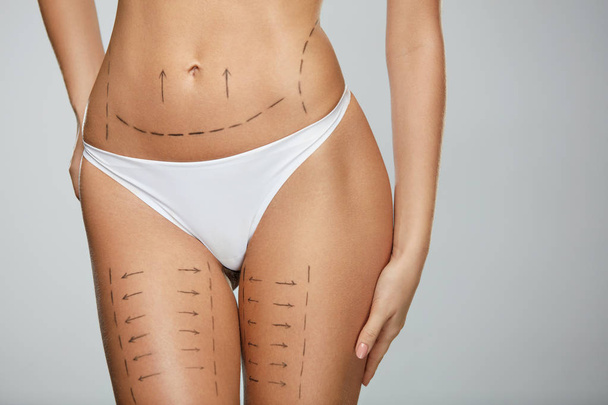 Surgical Lines. Woman Body In White Underwear With Marks On Skin - Fotó, kép