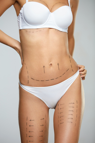 Beautiful Woman Body With Surgical Lines. Surgery Operation - Zdjęcie, obraz