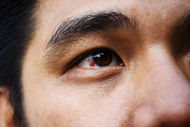 Vörös véraláfutásos szem - Fotó, kép