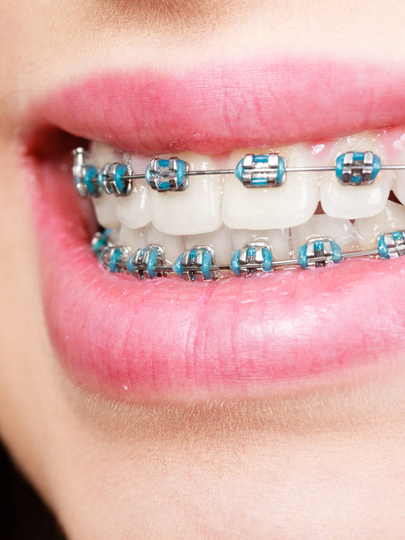 Woman showing her teeth with braces - 写真・画像