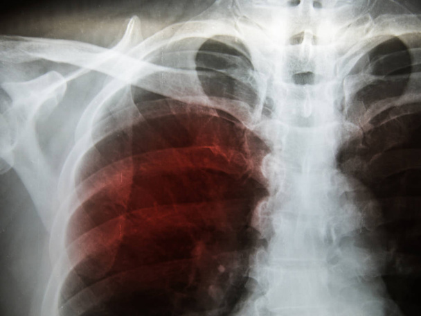Pulmonary Tuberculosis ( TB ) : Chest x-ray show alveolar infilt - Photo, Image