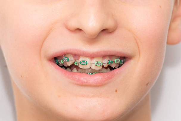 Stock photo of the metal braces  - Photo, Image