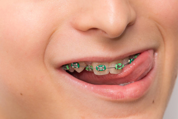 Metal diş telleri hazır fotoğraf  - Fotoğraf, Görsel