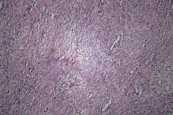 Клітини тканини матки людини з інвазивними пухлинними клітинами
 - Фото, зображення