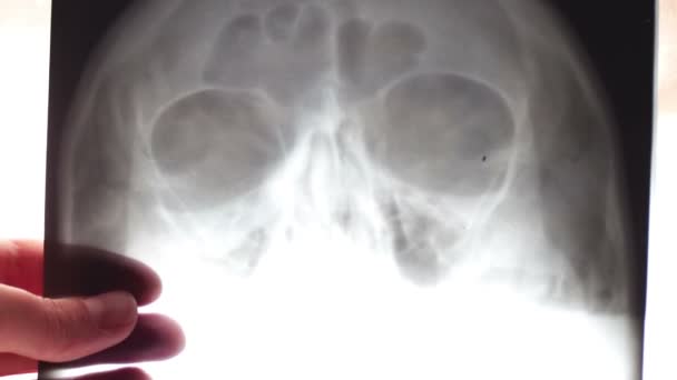 El médico mira la radiografía del cráneo humano y los senos maxilares
 - Imágenes, Vídeo