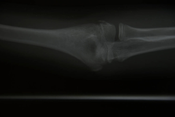 Close-up van gezamenlijke x-ray  - Foto, afbeelding
