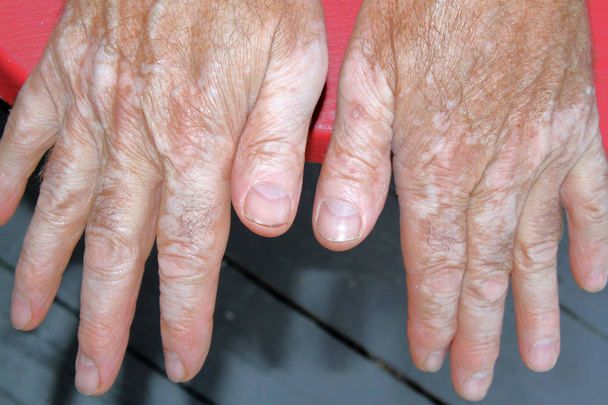 El vitiligo deri ile - Fotoğraf, Görsel