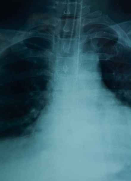 Az emberi mellkas röntgenképe  - Fotó, kép
