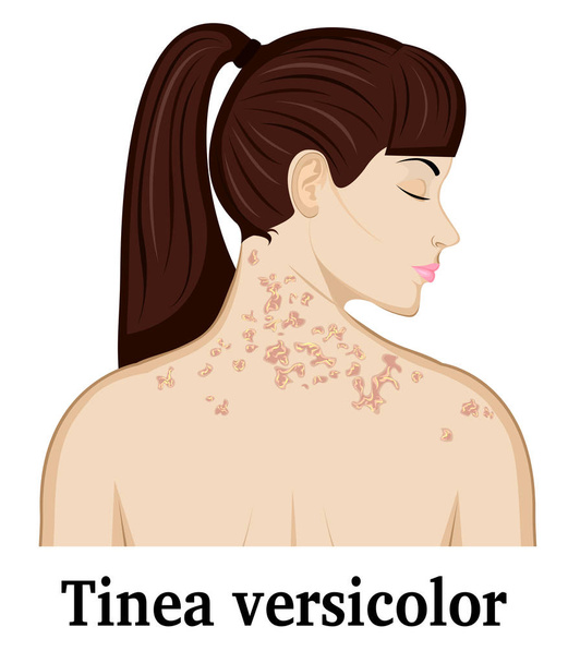 Illustratie van Tinea versicolor - Vector, afbeelding