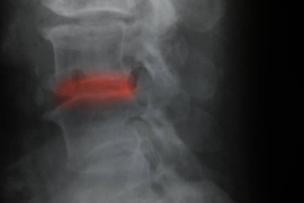 Close up spinal cord    - Photo, Image
