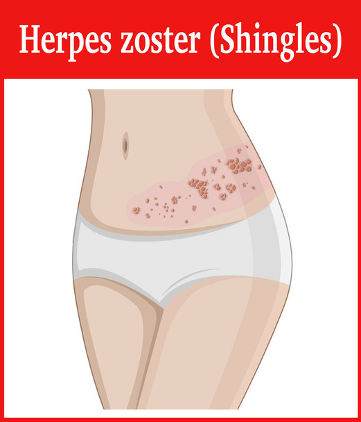 Illustration of Herpes zoster - Vector, Image