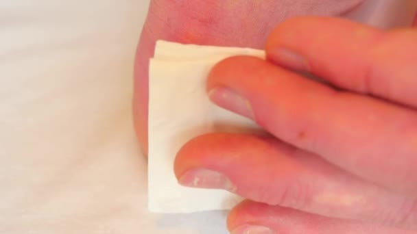 Hand trocknen und blutige Blasen an der Ferse mit Papiertaschentuch reinigen. ein schmerzhafter Ort mit gerissener Haut, blutiger und benetzter Wunde mit Hautbehaarung.  - Filmmaterial, Video