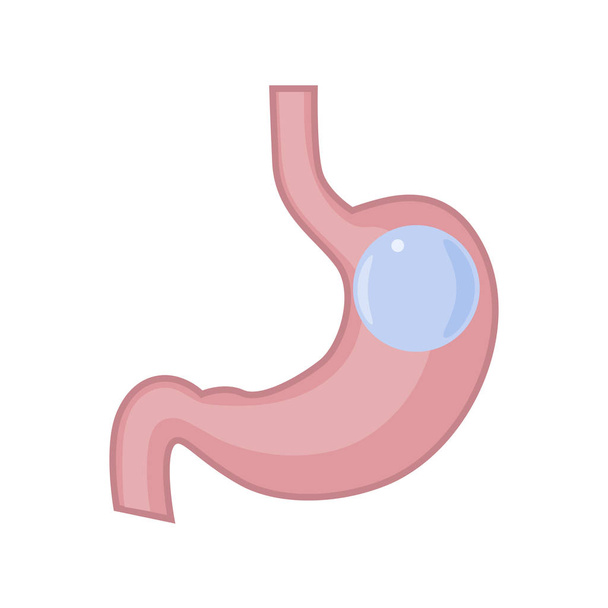 Gastric Balloon Stomach - Vector, Image