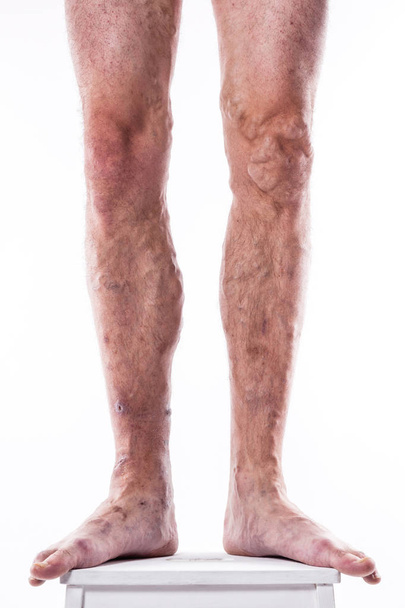 pernas humanas com veias bloqueadas
 - Foto, Imagem