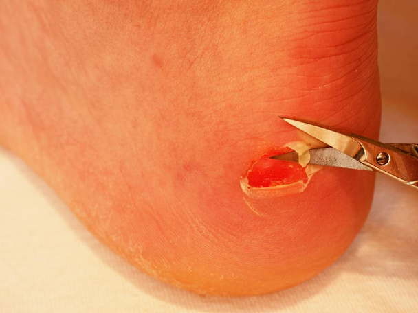 Makas kırık kanlı blister topuk üzerinde kuru deriyi kesme. Çok acı bir yırtık deri ile - Fotoğraf, Görsel