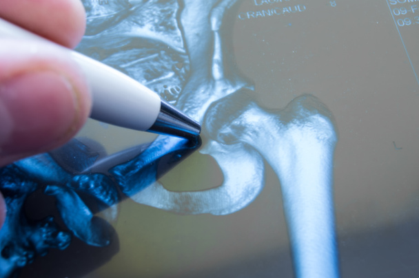 Radiographie de l'articulation de la hanche. Médecin pointé sur la zone de l'articulation de la hanche, où la pathologie est détectée, comme la fracture, la destruction de l'articulation, la coxarthrose, l'arthrose. Diagnostic des maladies articulaires par radiologie
 - Photo, image