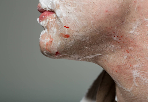 Мужское лицо, подбородок с кровью после бритья. Мужчина в ванной утром с гелем для бритья и ранами на лице. Человек с полотенцем перед зеркалом бреет бороду
 - Фото, изображение