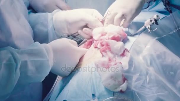 Хирург удаляет почку из брюшной полости
 - Кадры, видео