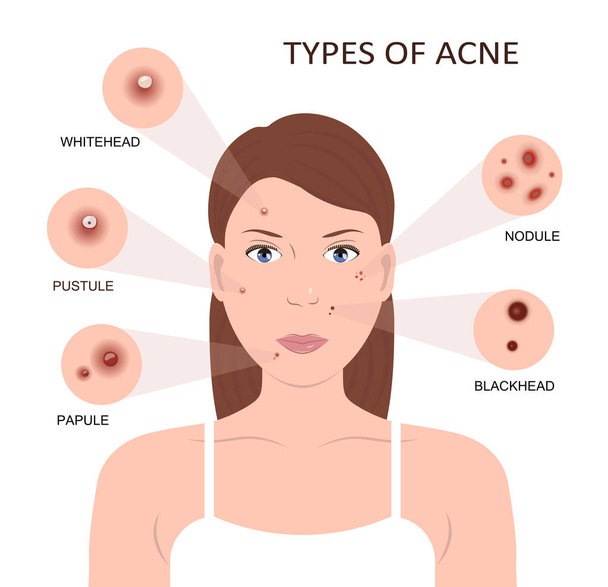 Types d'acné. Femme avec boutons
 - Vecteur, image