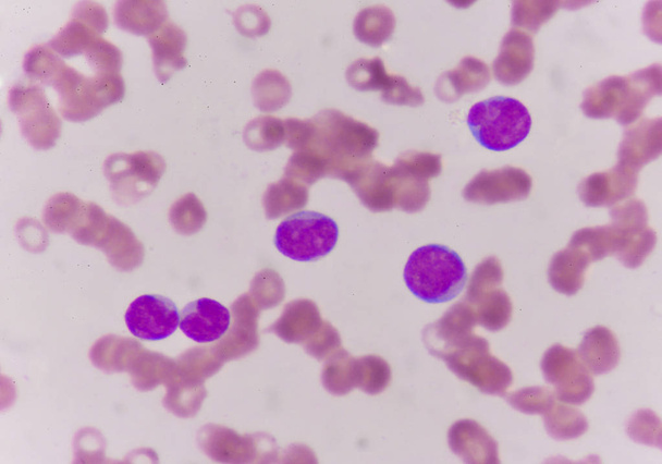 Blast cells in blood smear. - Photo, Image