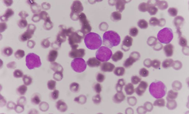 frotis de sangre se utiliza a menudo como una prueba de seguimiento
 - Foto, Imagen