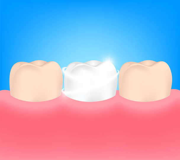 Impiallacciature dentali su un dente umano. Prima e dopo
. - Vettoriali, immagini