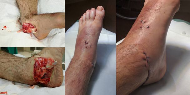Torção de tornozelo aberta antes e depois da cirurgia
. - Foto, Imagem