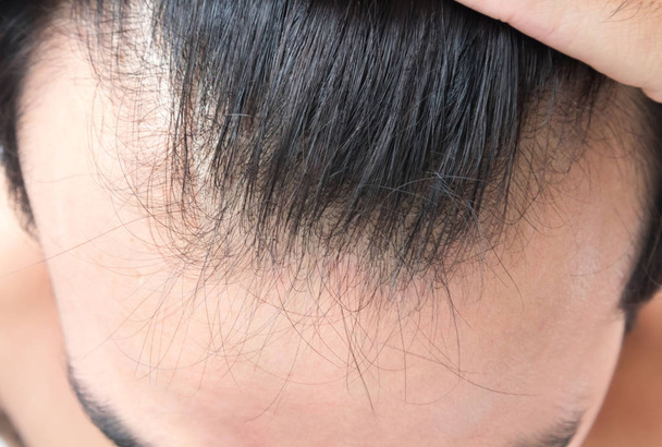 Jeune homme grave problème de perte de cheveux pour les soins de santé shampooing et produit de beauté concept
 - Photo, image