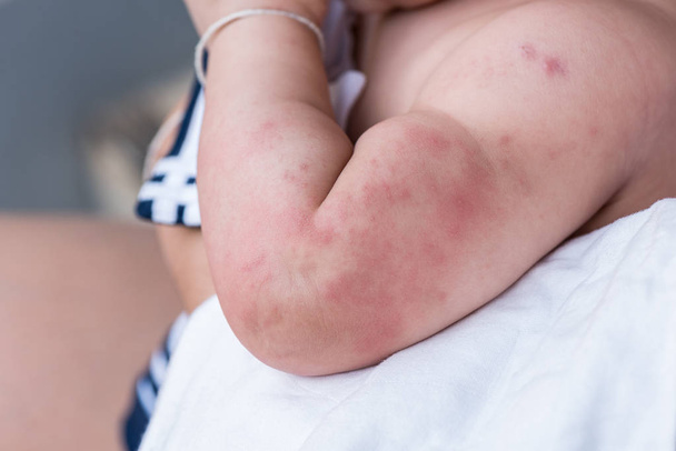 重度の蕁麻疹、発疹に苦しんで赤ちゃん肌の質感. - 写真・画像