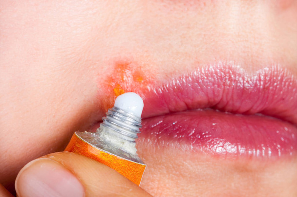Herpes on the lip close-up macro. Woman lubricates the labial herpes ointment - 写真・画像
