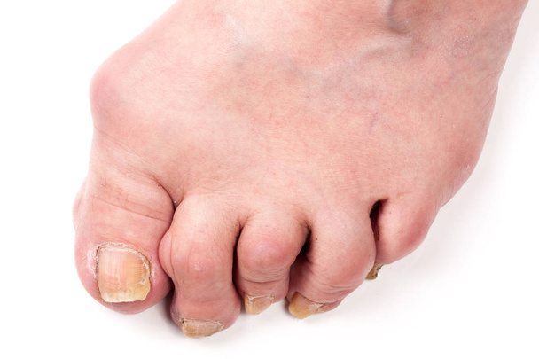 Rheumatoid polyarthritis on foot isolated on white background - Photo, Image