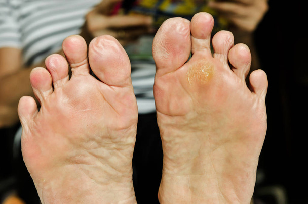 trattamento sulla verruca sotto i piedi da acido salicilico
 - Foto, immagini