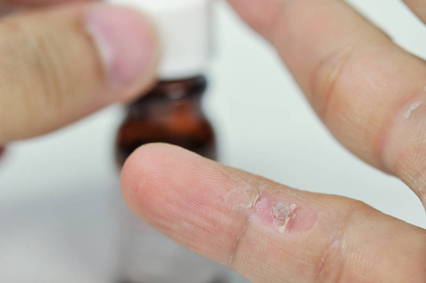 treatment wart on finger by salicylic acid. - Photo, Image
