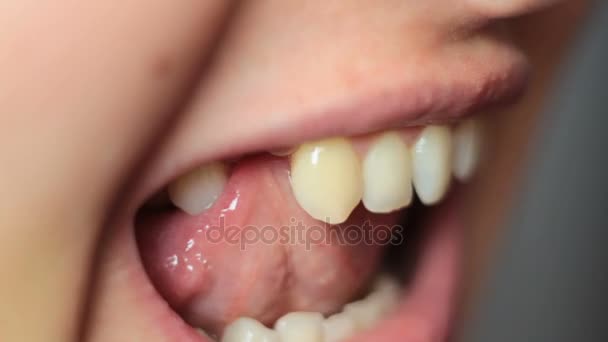 Dziewczyna idzie z języka na rany po ekstrakcji zęba - Materiał filmowy, wideo