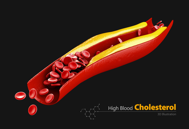 Cholesterin-Plaque in der Arterie, 3D-Illustration. isoliert schwarz - Foto, Bild