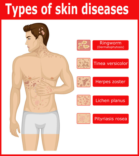 Tipos de doenças de pele
 - Vetor, Imagem