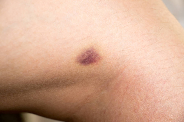 Kadın bacak arka plan üzerinde çürük yaralanma kapandı - Fotoğraf, Görsel