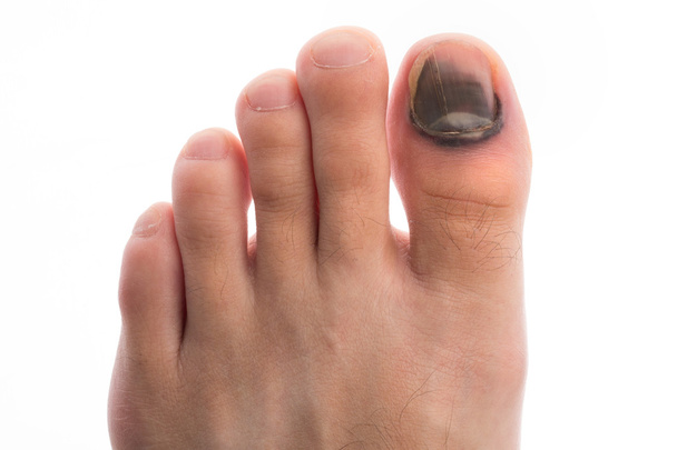 τραυματίσουν toenail - Φωτογραφία, εικόνα