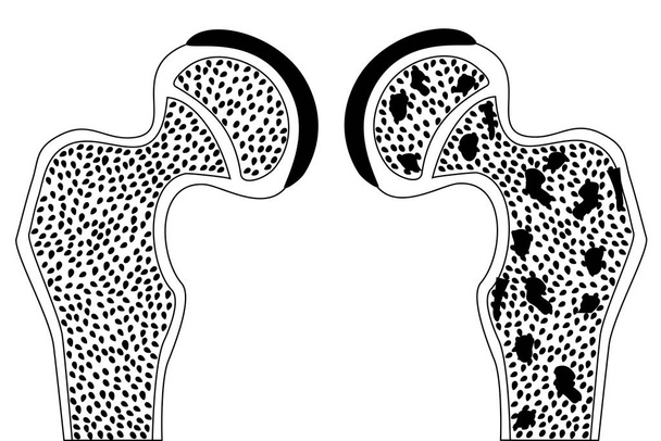 Osso do quadril saudável e com osteoporose
 - Vetor, Imagem