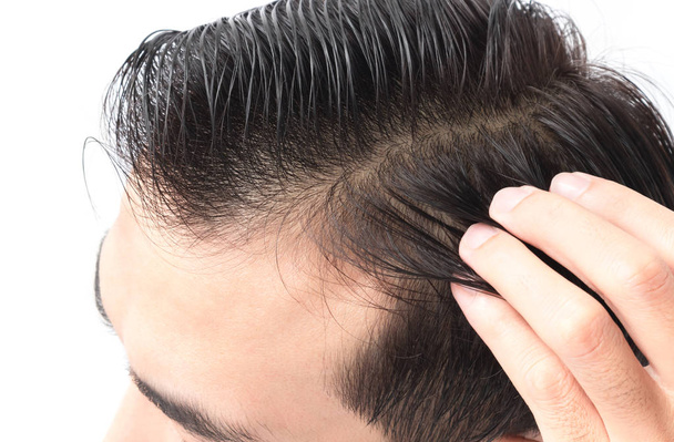 Młody mężczyzna problem utraty włosów poważne dla opieki zdrowotnej szampon i piękna koncepcji produktu - Zdjęcie, obraz
