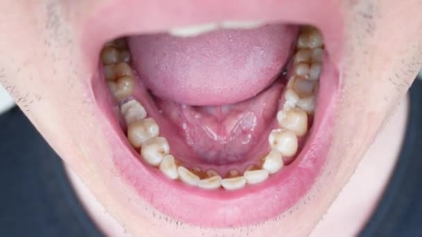 Man de mond opent en toont de tanden van de rokers met cariës en tandheelkundige Stone - Video