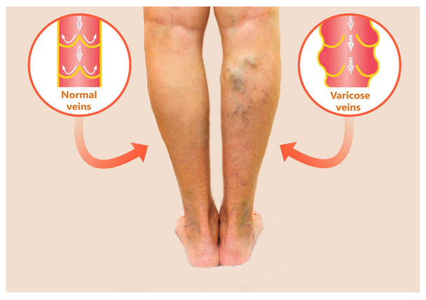 Veias varicosas em uma perna sênior feminina
 - Foto, Imagem