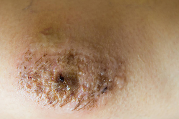 Закрита травма червоного шраму на коліно жінки
 - Фото, зображення