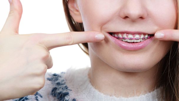 Happy woman showing her braces on teeth - Фото, зображення