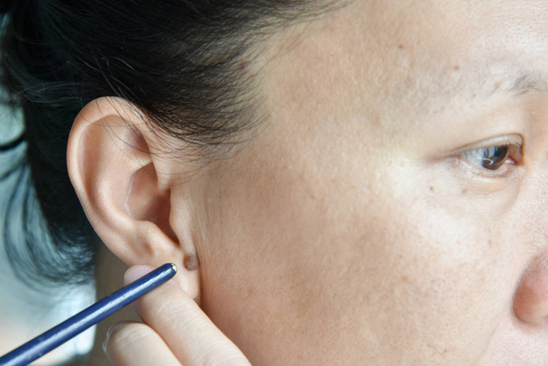 asiatische Frau zeigen Maulwurf auf Ihr Ohr - Foto, Bild