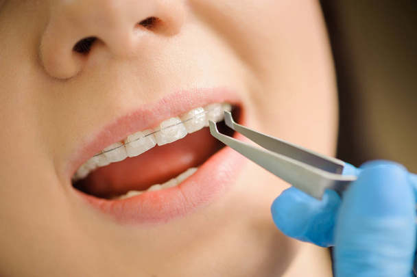 Γυναίκα με κεραμικά σιδεράκια στα δόντια στο οδοντικό γραφείο - Φωτογραφία, εικόνα