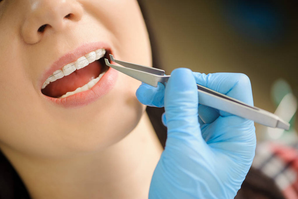 歯科医院で歯にセラミックのブレースを有する女性 - 写真・画像